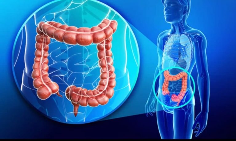 Waspadai Kanker Usus Besar! Ini Gejala, Pengobatan, dan Perawatannya